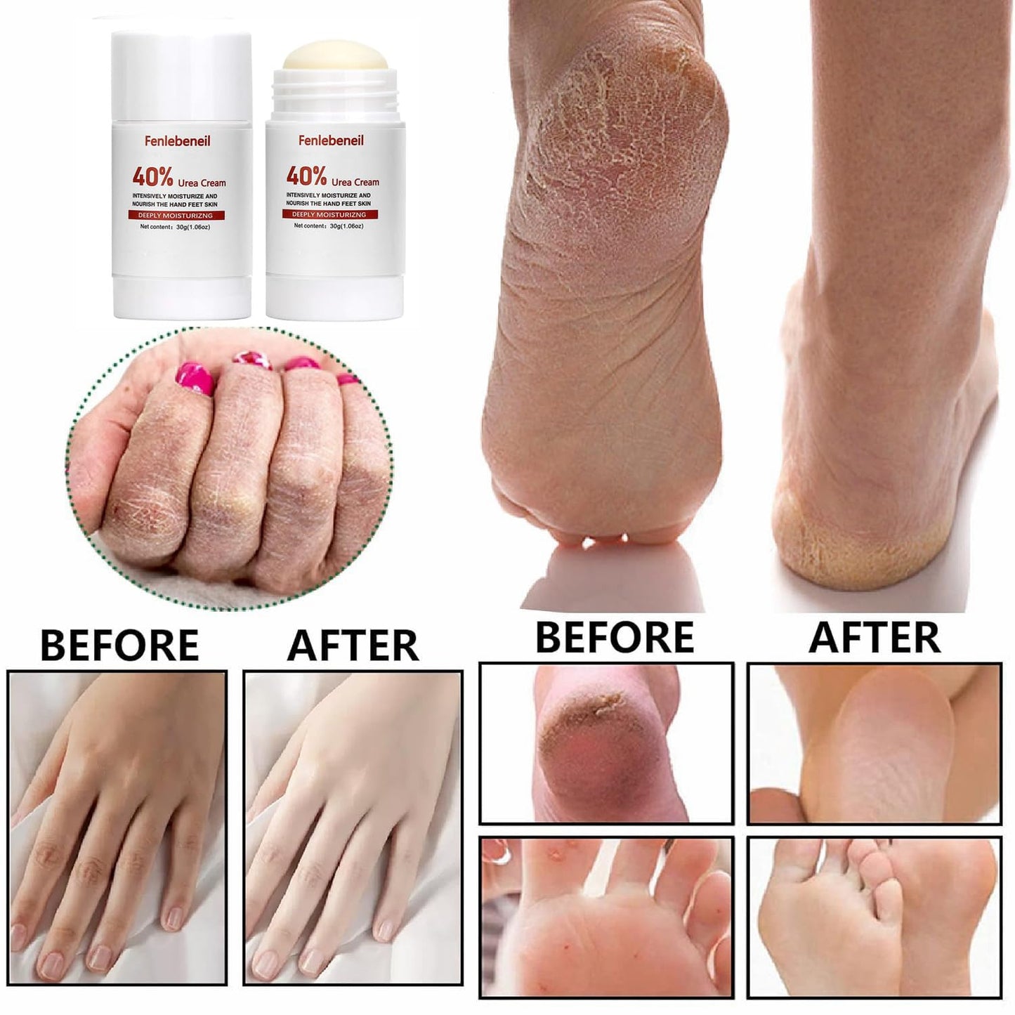 Urea Cream 40 Percent for Foot and Dry Cracked Heel 40% Urea Feet Cream Balm Stick for Foot Hand Moisturizing Feet Hand Care Balm for Women Men 1.06Oz