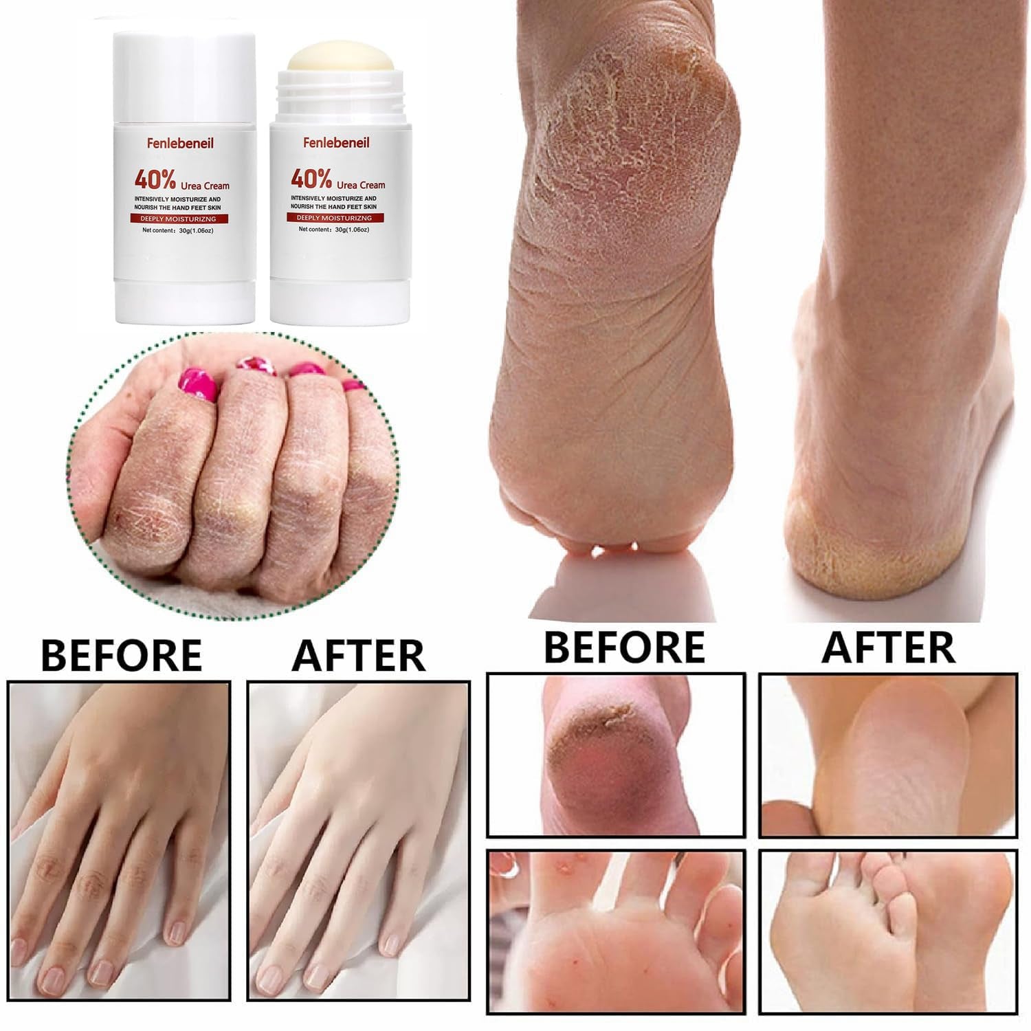 Urea Cream 40 Percent for Foot and Dry Cracked Heel 40% Urea Feet Cream Balm Stick for Foot Hand Moisturizing Feet Hand Care Balm for Women Men 1.06Oz