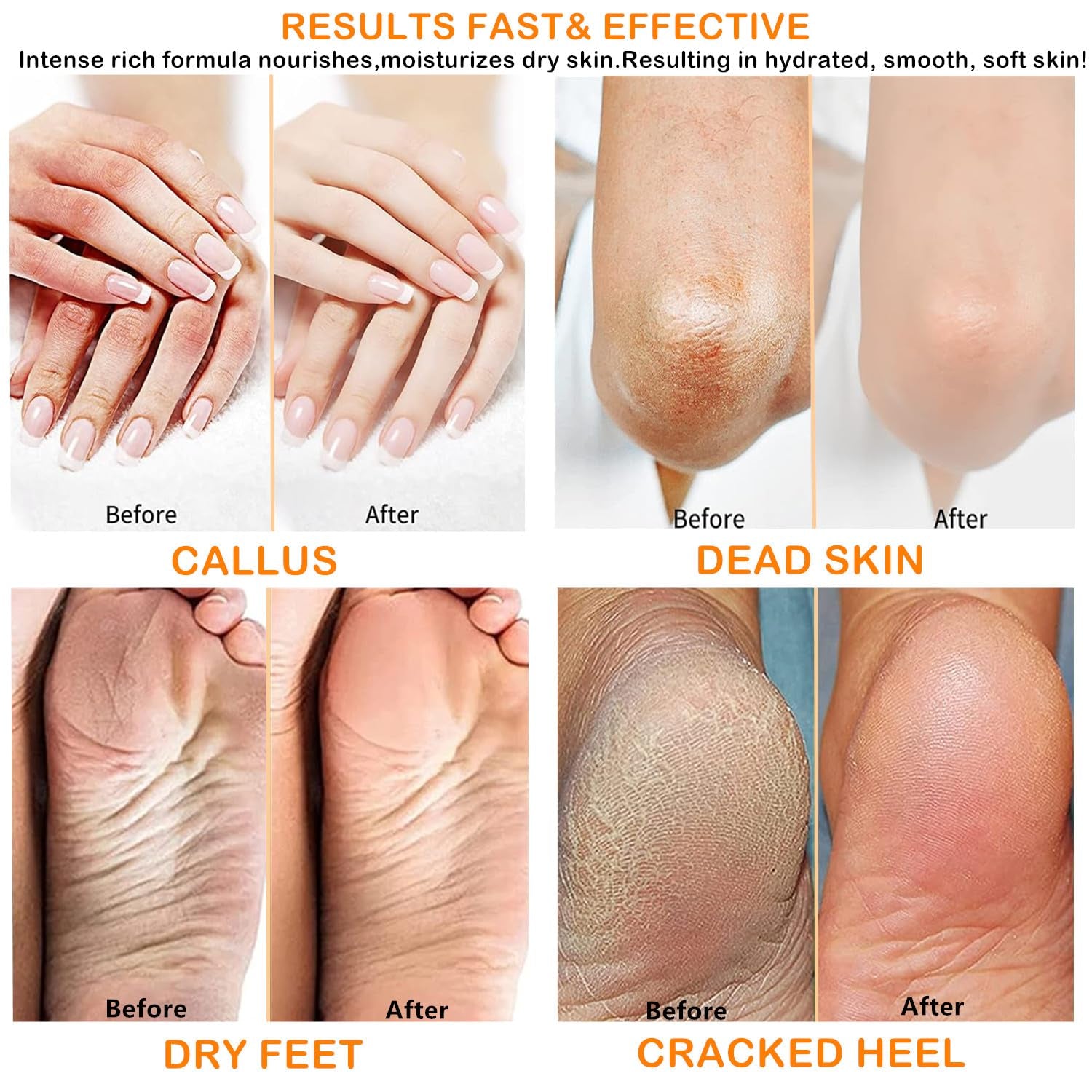 Urea Cream 40 Percent for Foot and Dry Cracked Heel 40% Urea Feet Cream Balm Stick for Foot Hand Moisturizing Feet Hand Care Balm for Women Men 1.06Oz